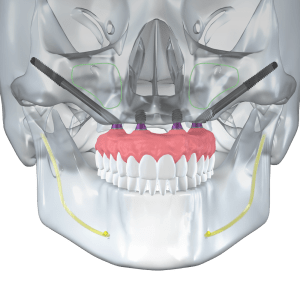 Zygomatic Implants